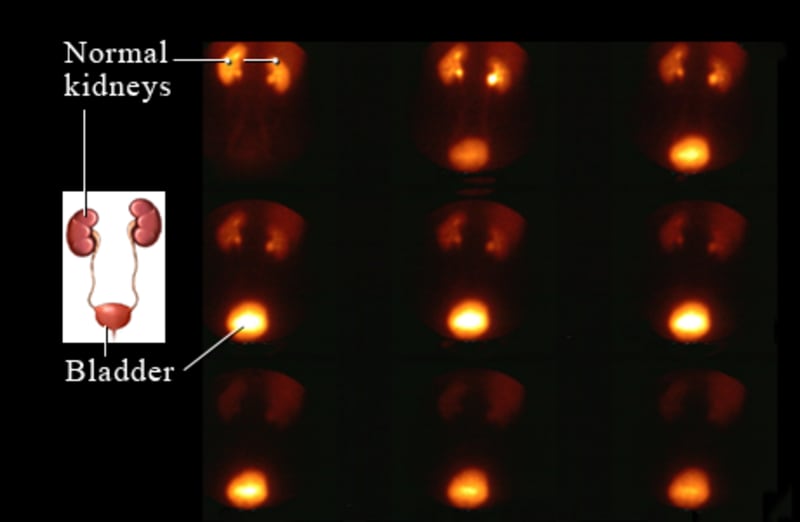 Normal kidney nuclear medicine scan