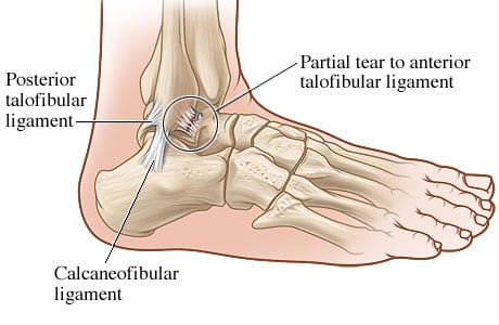 Closeup of ankle, showing posterior talofibular ligament, anterior talofibular ligament, and calcaneofibular ligament.