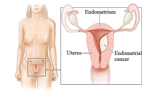 Endometrial cancer