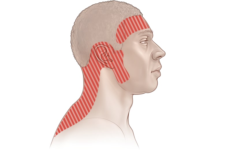 Possible areas of pain with tension headache