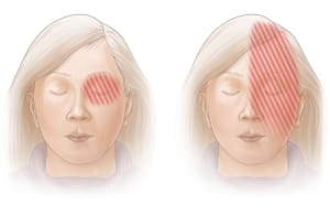 Areas of pain associated with migraine headaches