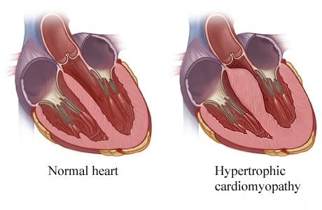 Inside views of normal heart and of heart with thicker walls from hypertrophic cardiomyopathy.