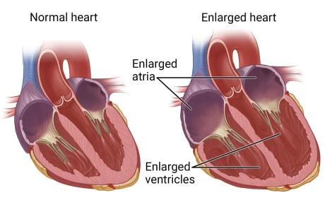 Inside view of a normal heart and a heart with chambers larger than normal.