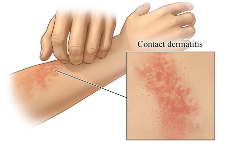 Contact dermatitis on arm, with close-up of rash.