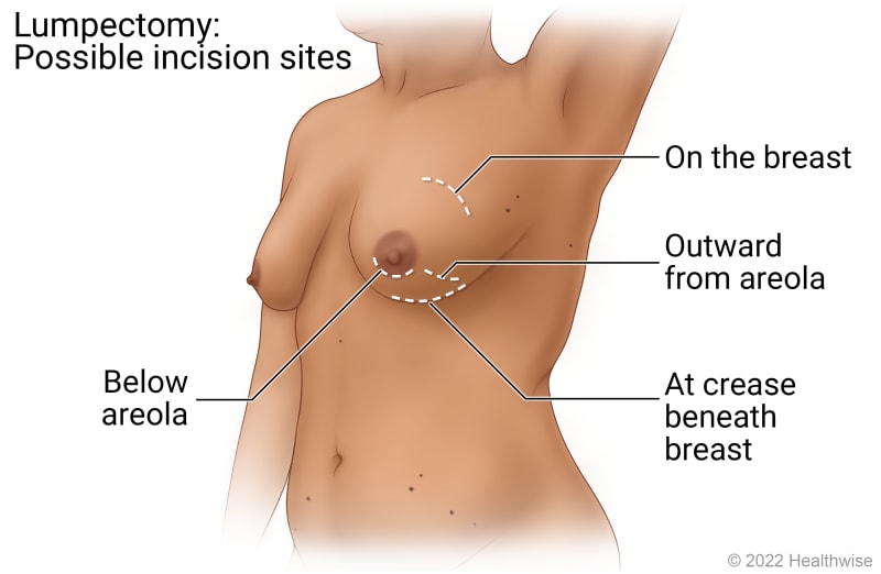 Possible incision sites for lumpectomy, including on the breast, below areola, outward from areola, and at crease beneath breast.
