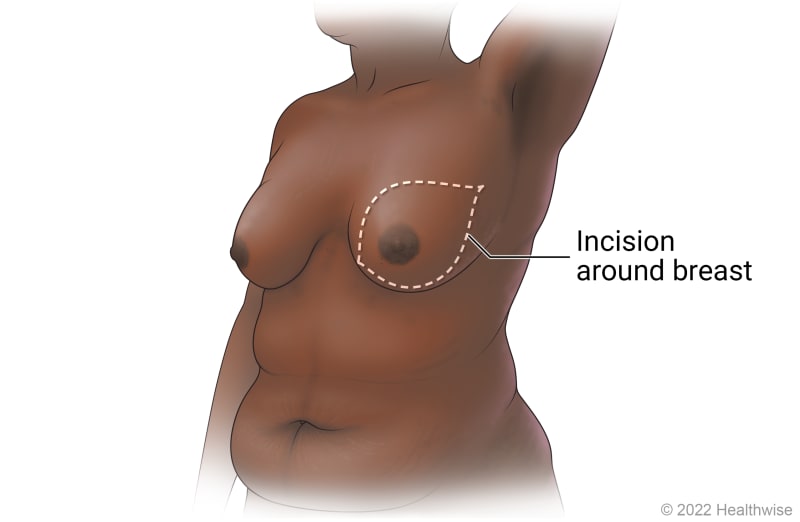 Breast, showing outline of incision around breast for mastectomy.