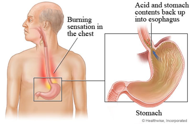 Heartburn from stomach to esophagus.