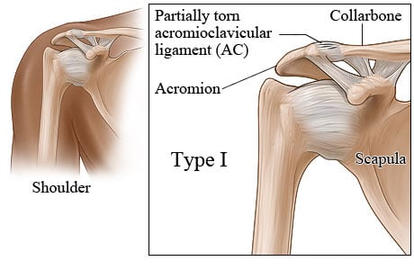 Shoulder anatomy, with close-up of type 1 shoulder separation with partially torn A.C. ligament.
