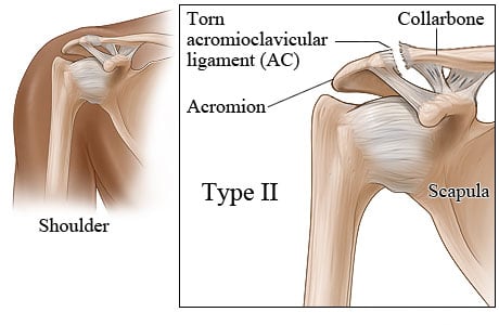 Shoulder anatomy, with close-up of type 2 shoulder separation with completely torn A.C. ligament.