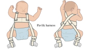 Splinting or Bracing | UK Healthcare